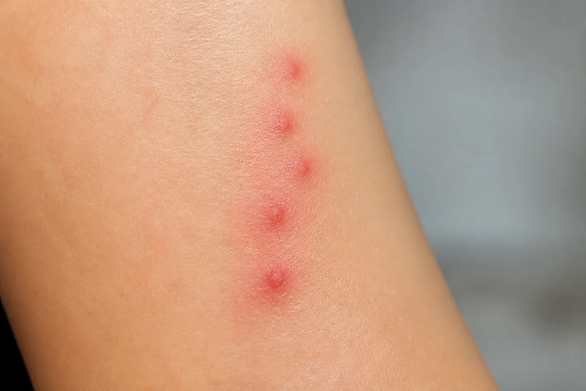 boutons de punaise de lit